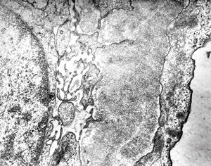 F,26y. | membranous glomerulopathy F,26y. | membranous glomerulopathy